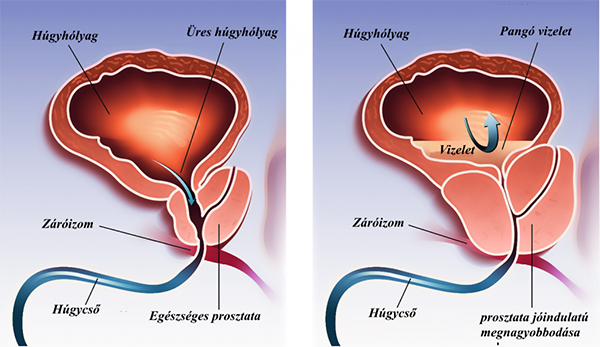adenocarcinoma prostate gleason 6